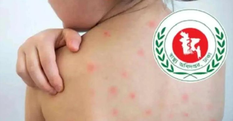 হামের উপসর্গে আরও পাঁচ শিশুর মৃত্যু
